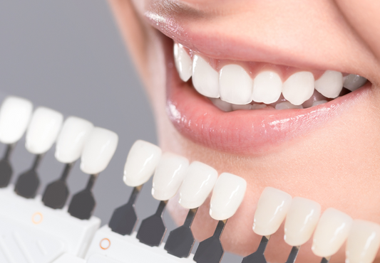 "Blanqueamiento dental: Consejos para mantener tus dientes blancos"